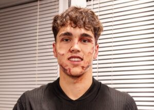 Pau Cubarsi's facial injury