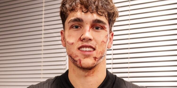 Pau Cubarsi's facial injury