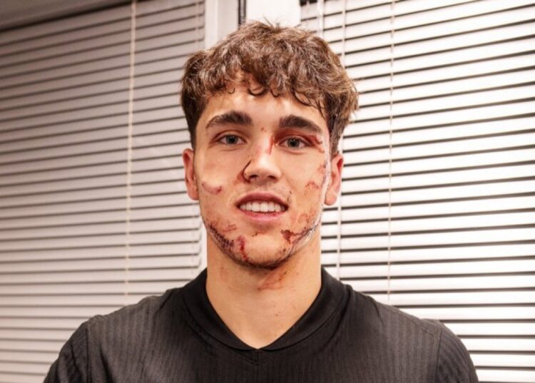 Pau Cubarsi's facial injury