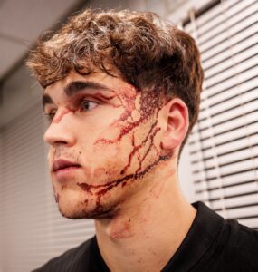 Pau Cubarsi's facial injury.